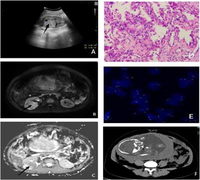 Pregnant patient with Xp11.2/transcription factor E3 translocation renal cell carcinoma: a case report and literature review